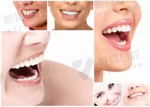 前牙美学修复步骤（前牙美学修复图片）(图1)